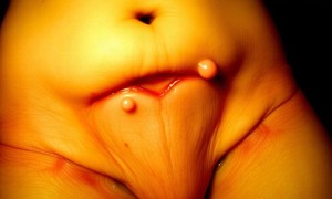 Цистит при эндометриозе: что происходит, когда очаги появляются на стенке мочевого пузыря