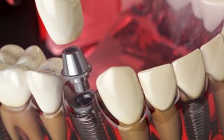 Как проводится имплантация зубов?