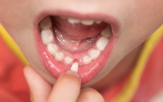 Когда надо удалить постоянный зуб: причины, процедура и последствия