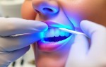 Белоснежная улыбка без лишней суеты: что на самом деле происходит при отбеливании в клинике