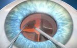 Что нужно делать с целью профилактики катаракты?