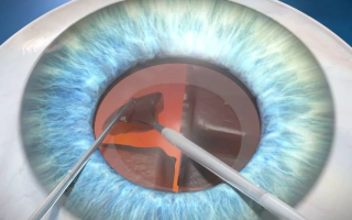 Что нужно делать с целью профилактики катаракты?