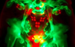 Лазерная коагуляция при лучевом цистите: что это за метод и когда он нужен