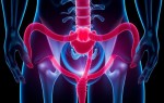 Лечение цистита: как быстро вернуть себе комфорт и избежать повтора