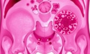 Плоскоклеточный рак мочевого пузыря: что важно знать о редкой, но агрессивной опухоли