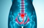 Цистит при пельвиоперитоните: как воспаление выходит за пределы малого таза