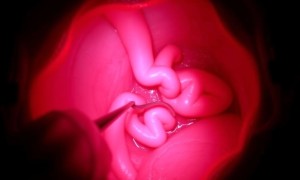Цистоскопия при цистите: как подготовиться и что ожидать