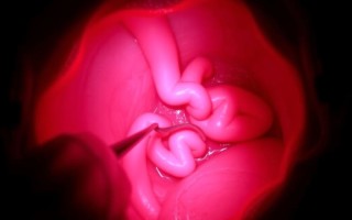 Цистоскопия при цистите: как подготовиться и что ожидать