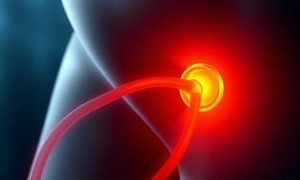 Цистит после установки катетера: как снизить риск осложнений и сохранить спокойствие