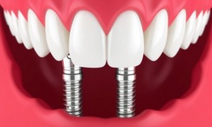 All-on-4: как вернуть улыбку за одно посещение клиники