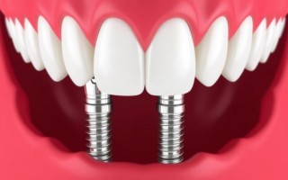 All-on-4: как вернуть улыбку за одно посещение клиники