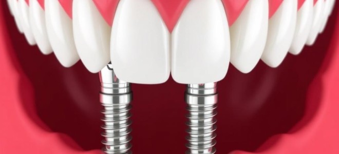 All-on-4: как вернуть улыбку за одно посещение клиники