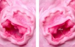 Атрофические изменения слизистой у женщин в постменопаузе и риск цистита: что важно знать и как действовать