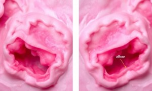 Атрофические изменения слизистой у женщин в постменопаузе и риск цистита: что важно знать и как действовать