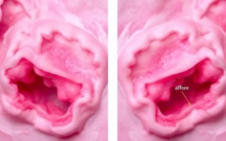 Атрофические изменения слизистой у женщин в постменопаузе и риск цистита: что важно знать и как действовать