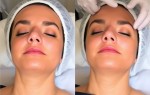 Фотомоложение BBL: как свет помогает вернуть коже свежесть и тонус