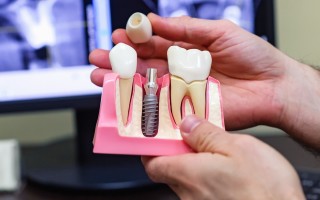 Как устанавливается имплант на зуб?