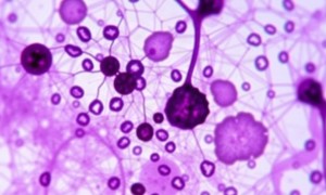Цитология мочи: что показывает анализ на атипичные клетки и зачем его назначают