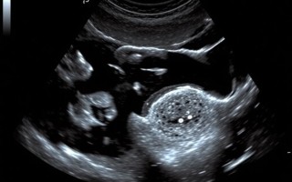 УЗИ матки и яичников: понятная инструкция для тех, кто собирается на обследование