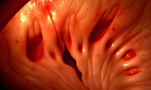 Цистит при анальных трещинах: как соседние очаги воспаления могут влиять друг на друга