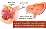 Регургитация на клапане легочной артерии 1 степени: что это значит и как с этим жить?