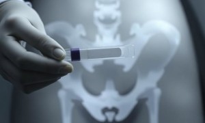 ПЦР‑тесты при цистите: какие инфекции выявляют в первую очередь и зачем это нужно
