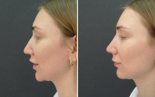 Причины появления горбинки на носу