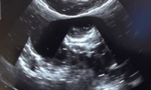 УЗИ мочевого пузыря при цистите: что может показать снимок и зачем это нужно