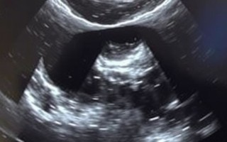 УЗИ мочевого пузыря при цистите: что может показать снимок и зачем это нужно