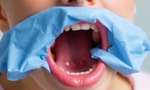 Месна: защита слизистой при химиотерапии