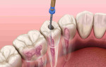 Лечение нерва зуба: как избежать боли и сохранить зубы