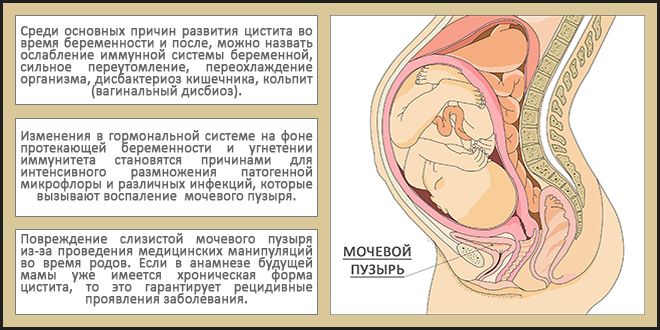 Лечение цистита у женщин при кормлении thumbnail