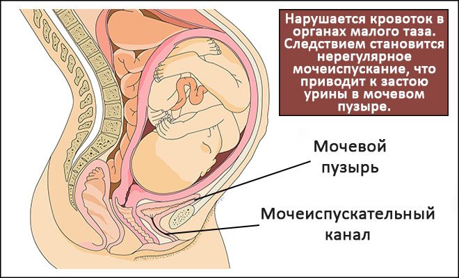 Воспаление мочевого пузыря у женщины лечение в домашних условиях thumbnail