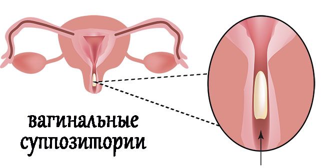 vaginalnye suppozitorii
