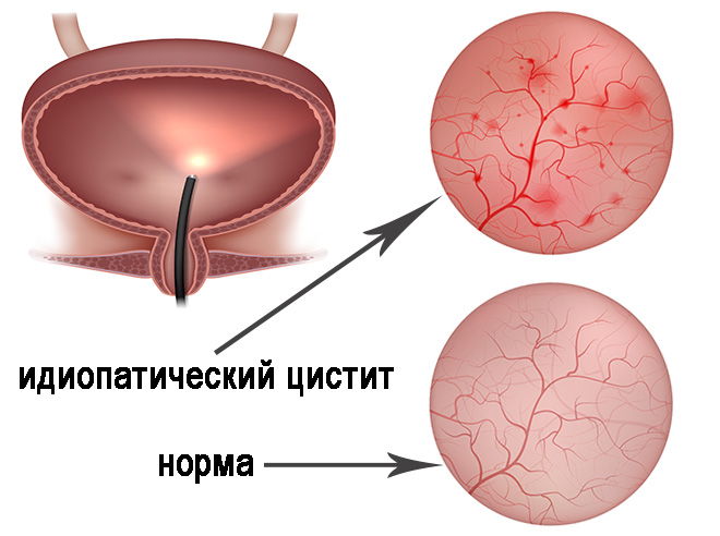 идиопатический/интерстициальный