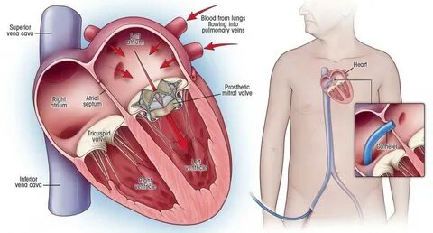 Как проводится замена клапана сердца?