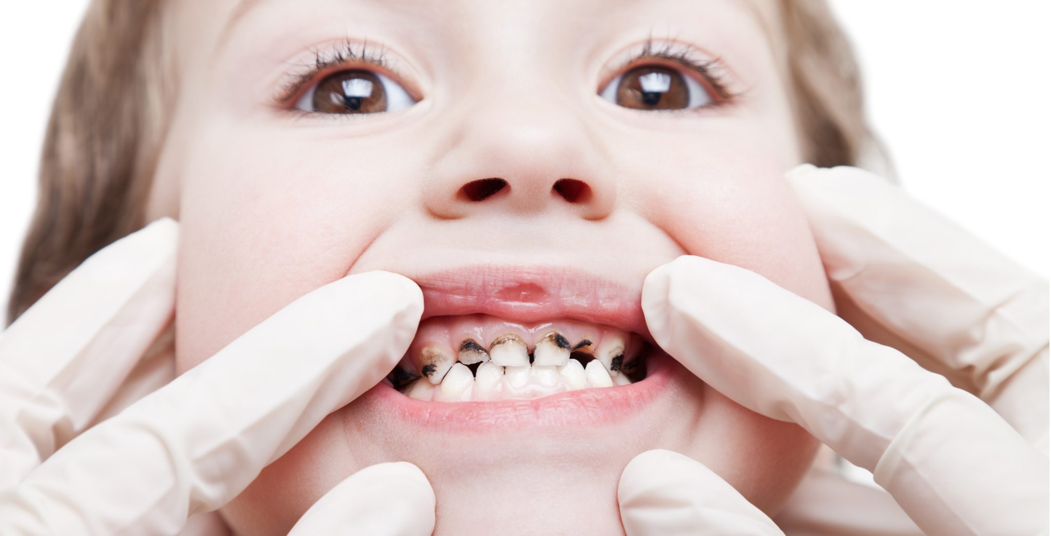 Что такое серебрение молочных зубов?