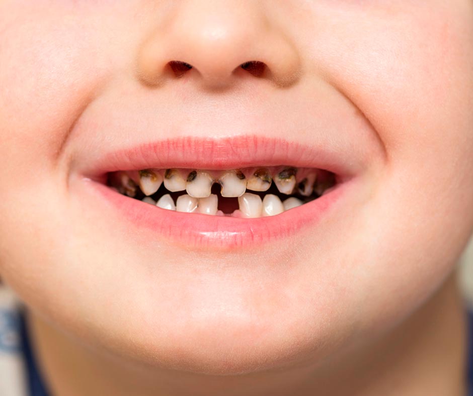 Что такое серебрение молочных зубов?