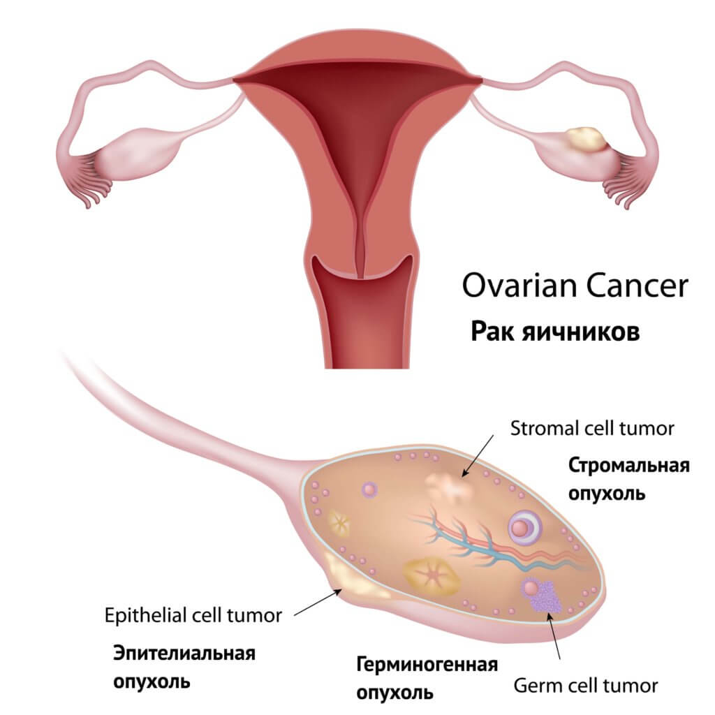 Способы лечения рака шейки матки