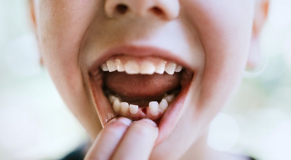 Когда надо удалить постоянный зуб: причины, процедура и последствия