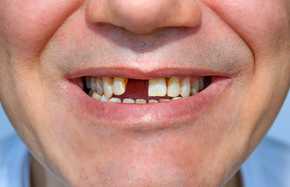 Как избежать риска потери зубов: эффективное лечение рецессии десны