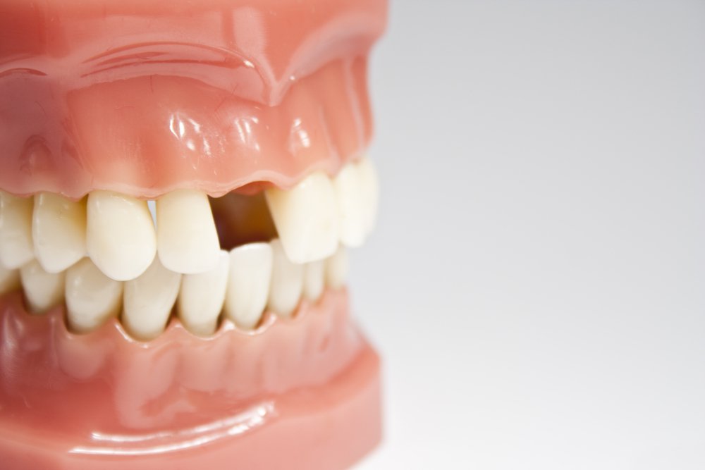 Как избежать риска потери зубов: эффективное лечение рецессии десны