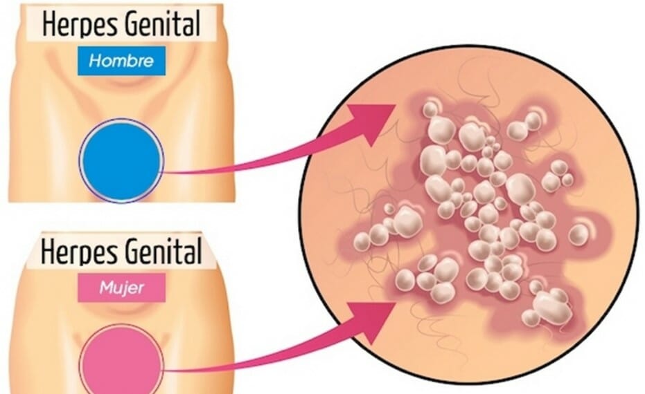 Что такое генитальный герпес и почему важно его лечить